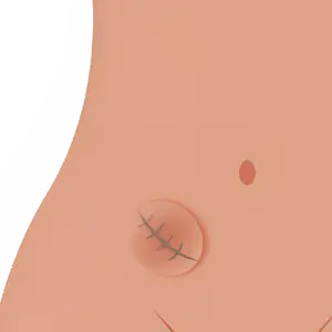 Cirugía de Hernia en Monterrey