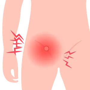 Cirugía de Hernia en Monterrey