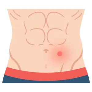 Cirugía de Hernia en Monterrey