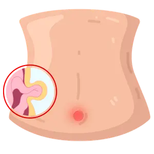 Cirugía de Hernia en Monterrey