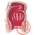 fistulas anales