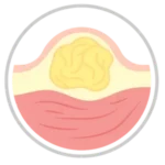 lipomas