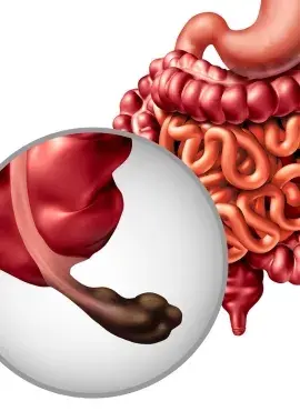 apendicitis Apendicetomía en Monterrey