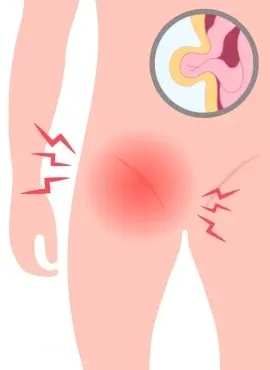 como se ve una hernia inguinal Cirugía de Hernia Inguinal en Monterrey