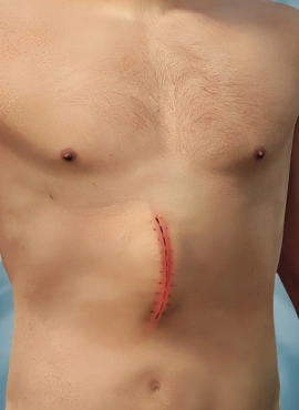hernia incisional Cirugía de Hernia Incisional en Monterrey