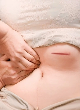incision Cirugía de Hernia Incisional en Monterrey