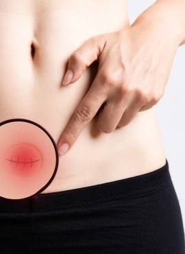 incisional hernia Cirugía de Hernia Incisional en Monterrey