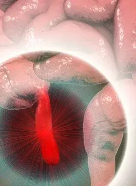 inflamacion de apendice Apendicetomía en Monterrey