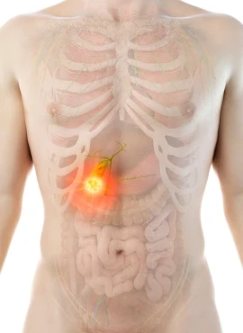 Cirugía de Vesícula en Monterrey